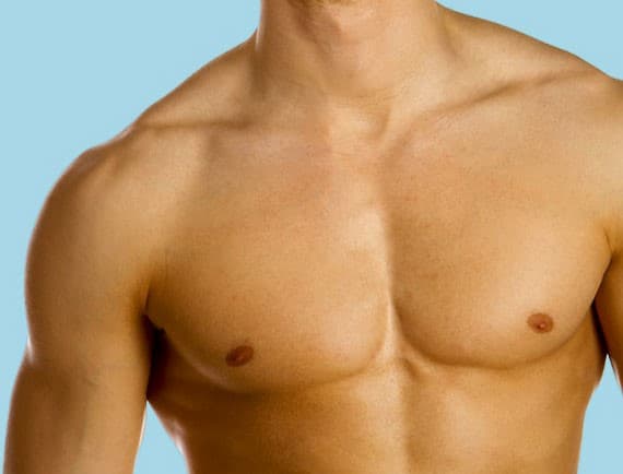 massive gynaecomastia correction in Hyderabad Image of massive gynaecomastia correction in Hyderabad
