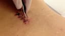 Suture removal at home in Chennai
