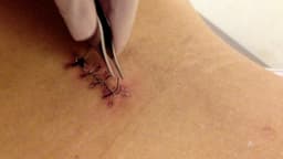 Image for Suture removal at home in Chennai