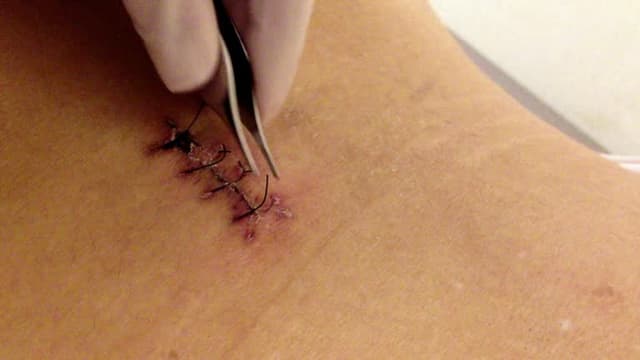 Suture removal at home in Chennai Image of Suture removal at home in Chennai