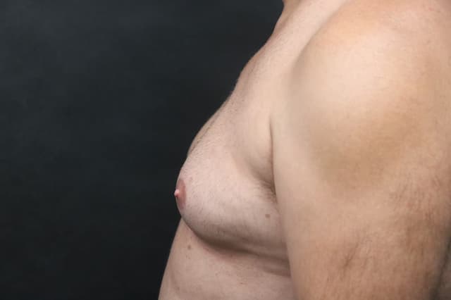Hi Def gynecomastia surgery in Hyderabad Image of Hi Def gynecomastia surgery in Hyderabad