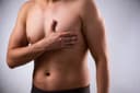 Gynaecomastia specialist in Hyderabad