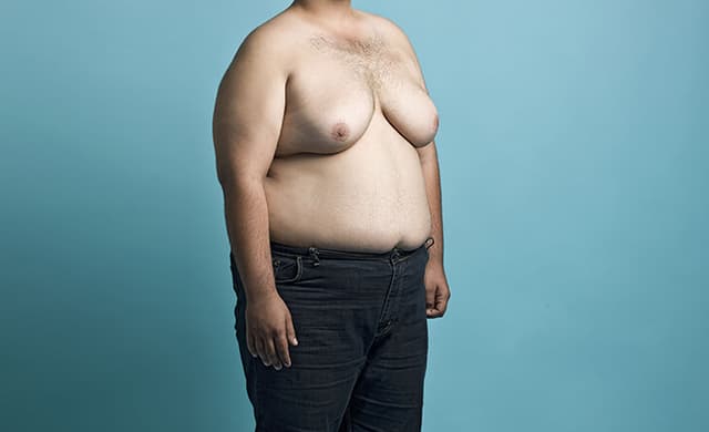 Best gynecomastia surgery clinic Hyderabad Image of Best gynecomastia surgery clinic Hyderabad