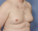 Skin excision gynaecomastia surgery cost in Hyderabad