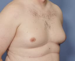 Image for Skin excision gynaecomastia surgery cost in Hyderabad