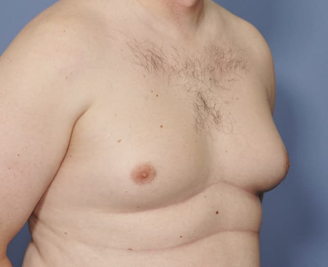 Skin excision gynaecomastia surgery cost in Hyderabad Image of Skin excision gynaecomastia surgery cost in Hyderabad