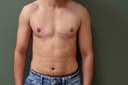 male areola reduction surgery cost in Hyderabad