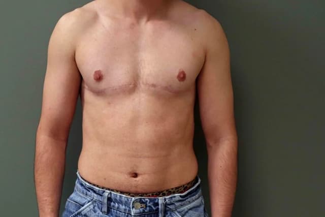 male areola reduction surgery cost in Hyderabad Image of male areola reduction surgery cost in Hyderabad