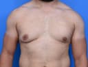 skin excision gynaecomastia surgery in Hyderabad