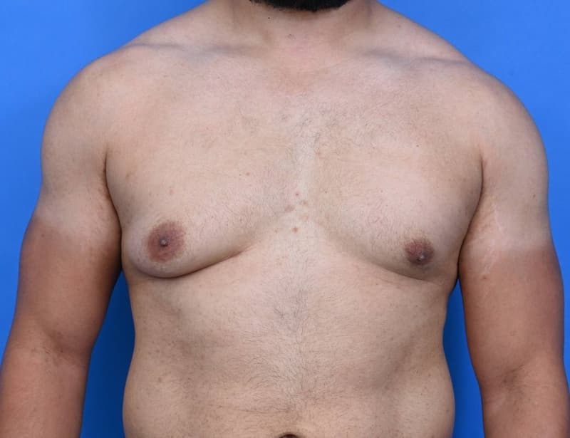 skin excision gynaecomastia surgery in Hyderabad