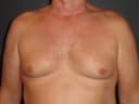 Gynaecomastia surgery Hyderabad