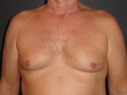 Image for Gynaecomastia surgery Hyderabad