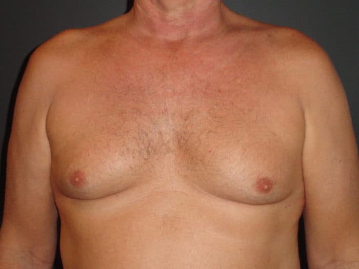 Gynaecomastia surgery Hyderabad