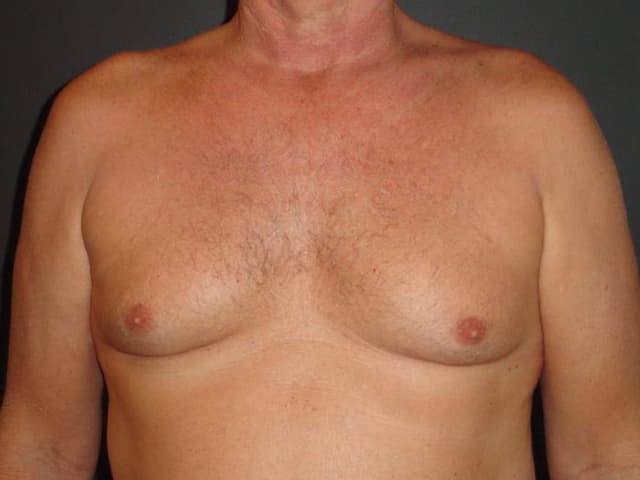 Gynaecomastia surgery Hyderabad Image of Gynaecomastia surgery Hyderabad