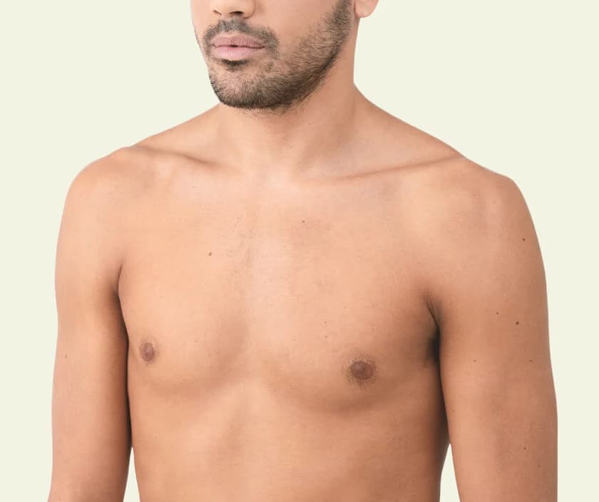 keyhole gynaecomastia surgery in Hyderabad