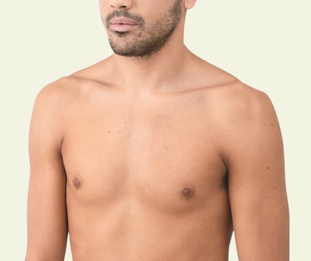 keyhole gynaecomastia surgery in Hyderabad Image of keyhole gynaecomastia surgery in Hyderabad